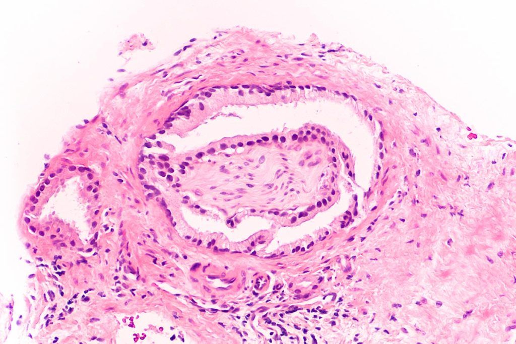 Biopsia del tumore alla prostata adenocarcinoma