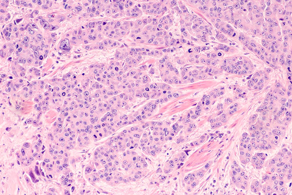 Carcinoma uroteliale papillare di alto grado tumore alla vescica