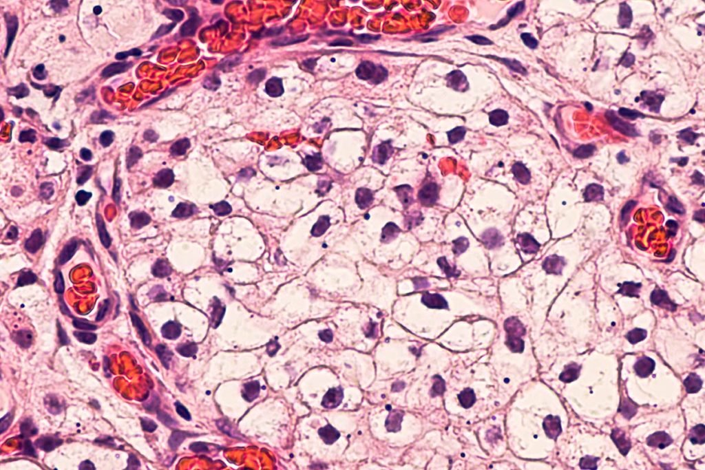 Carcinoma a cellule chiare tumore del rene