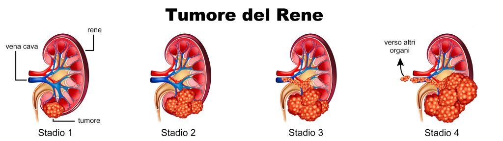 Stadi del tumore del rene