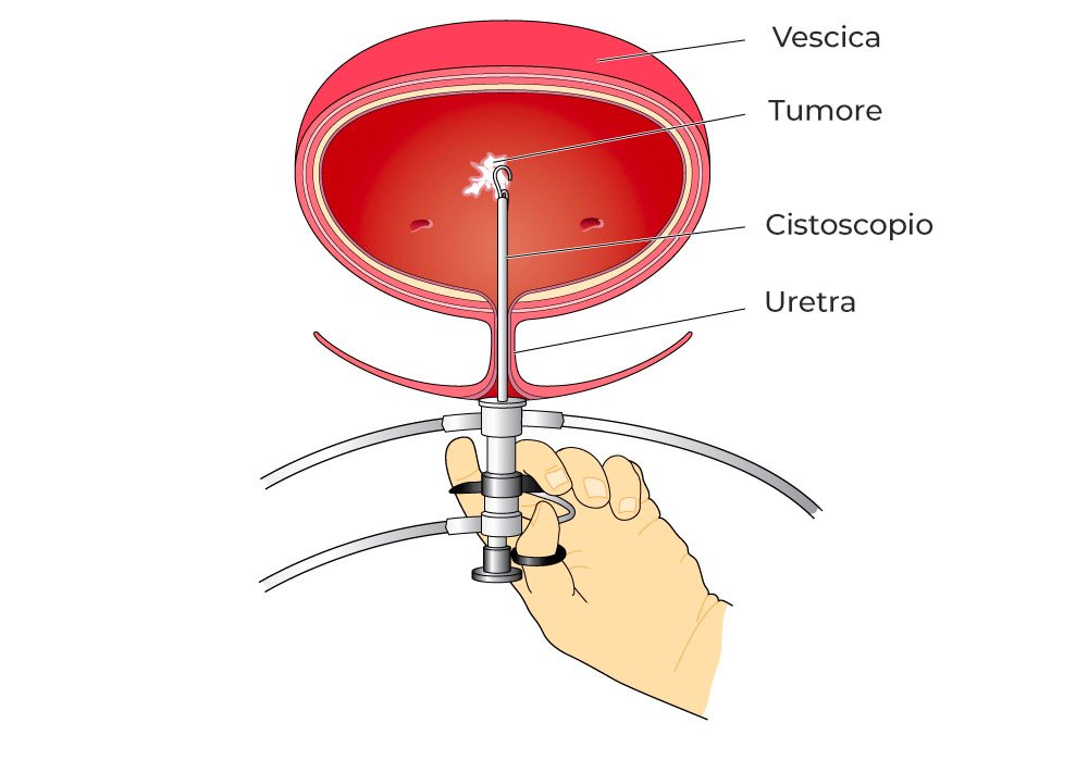 Cistoscopia diagnosi del tumore alla vescica