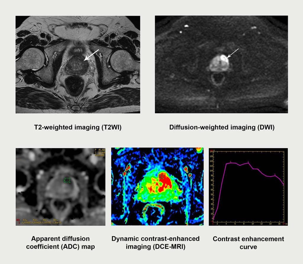 Risonanza Magnetica Tumore della Prostata
