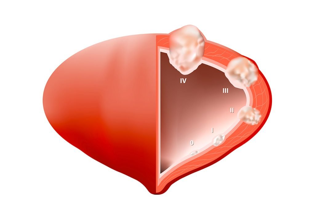 Stadiazione del tumore della vescica