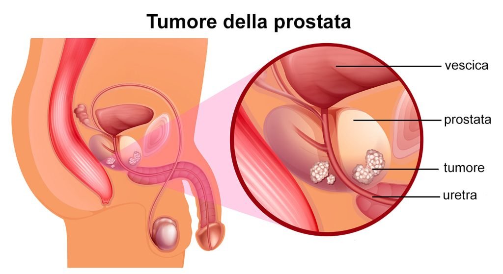 Tumore della Prostata