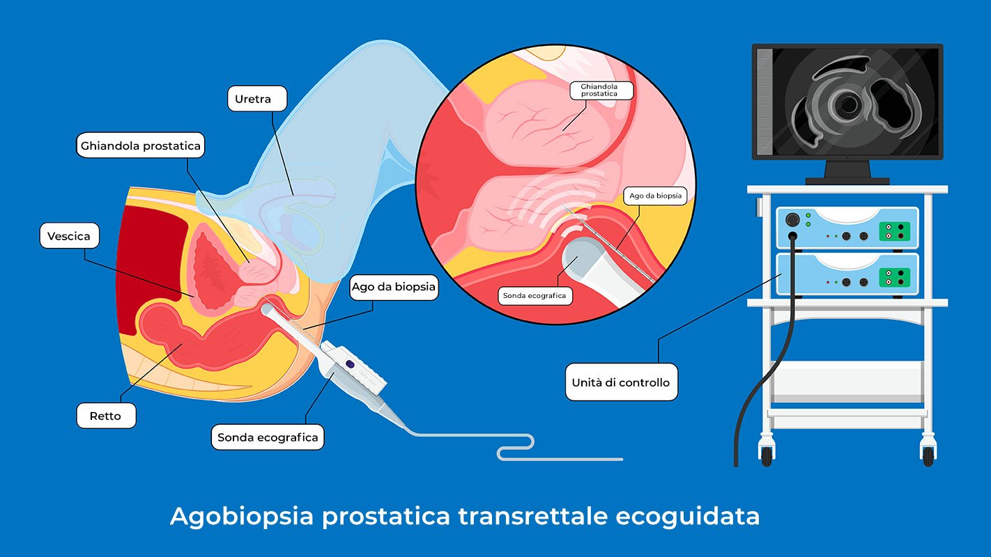 Agobiopsia prostatica transrettale ecoguidata