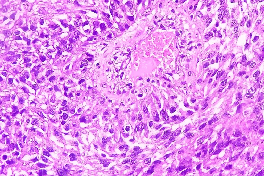 Carcinoma del rene a cellule chiare metastatico