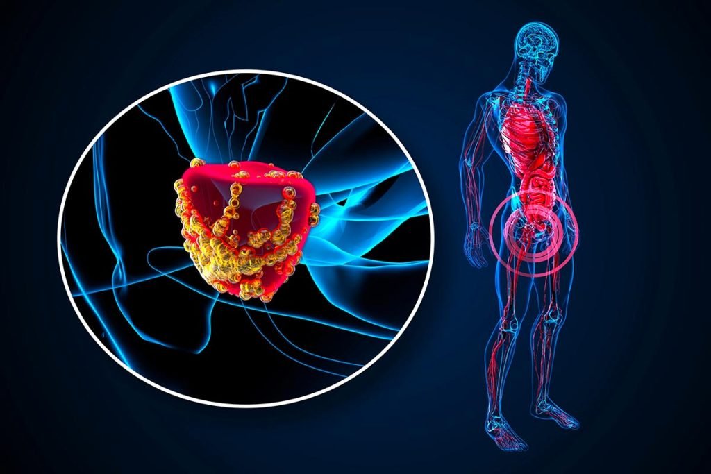 Carcinoma prostatico