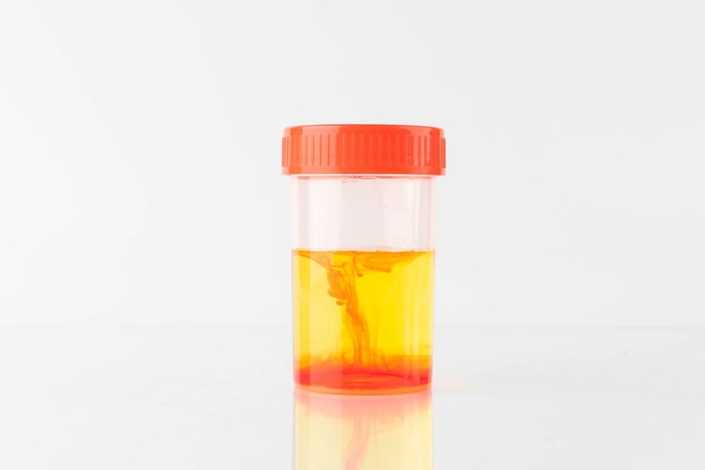 Ematuria Tumori Urologici