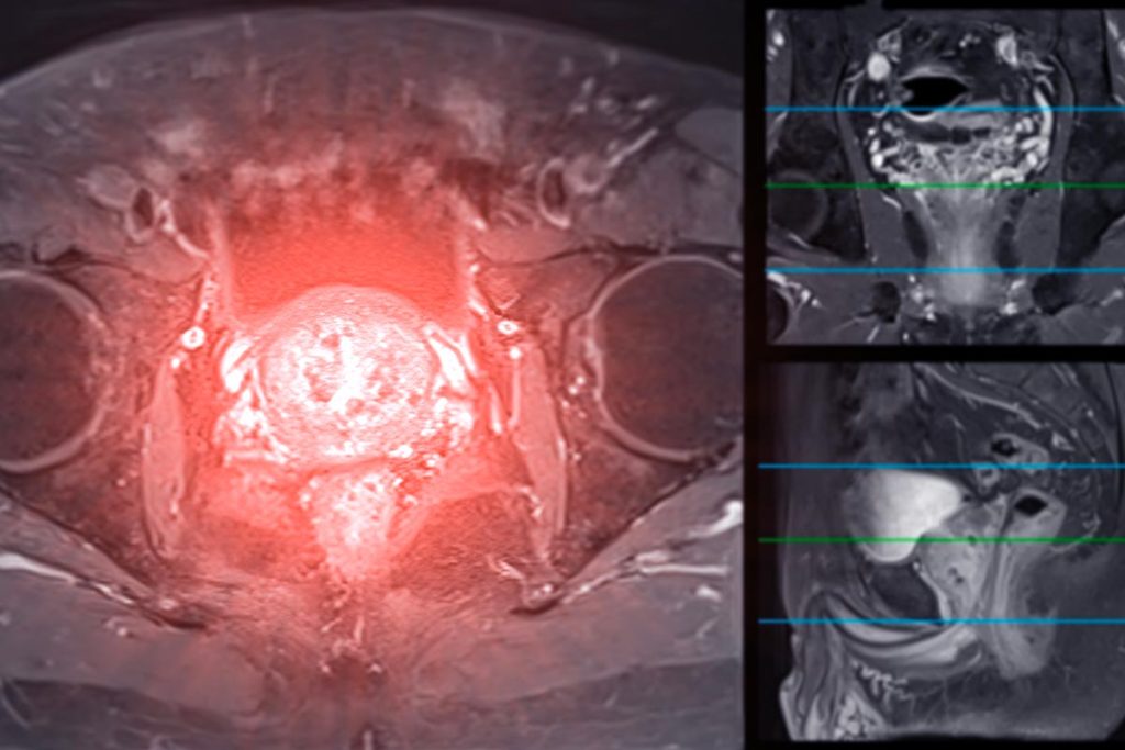 Risonanza Magnetica della Prostata