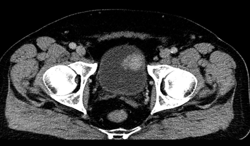 TAC della vescica