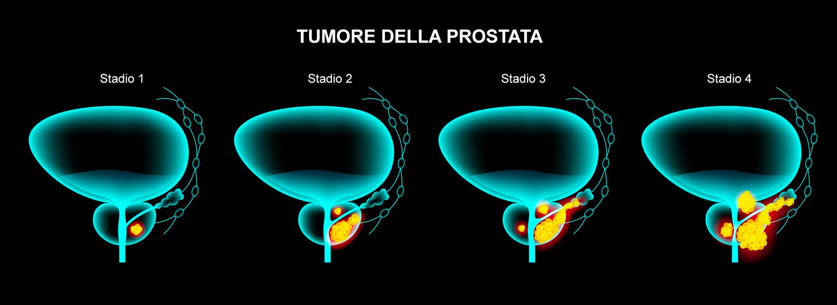 Stadi del tumore prostatico