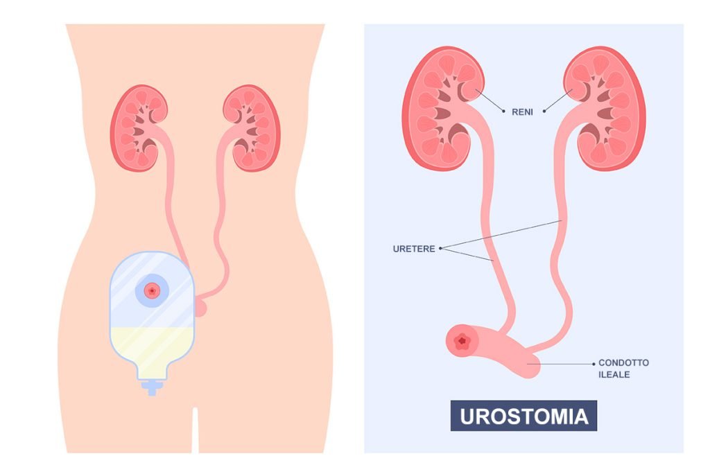 Urostomia